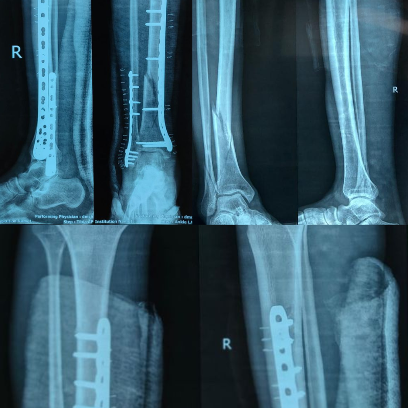 07 days old closed fracture distal shaft of Tibia-Fibula (Rt) in a 45yrs old male.