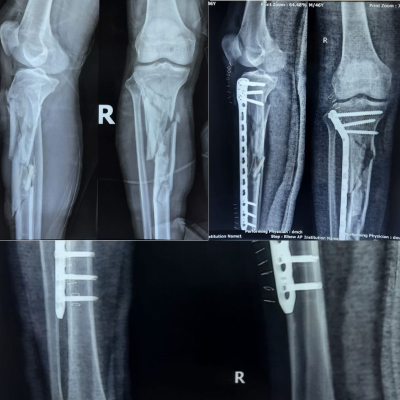 18 days old open comminuted fracture proximal shaft of right tibia(G-I) in a 40 years male