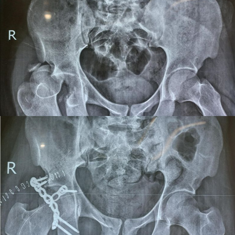 21 days old closed fracture posterior wall of right acetabulum with post reduction status of right hip of 28 years old male.