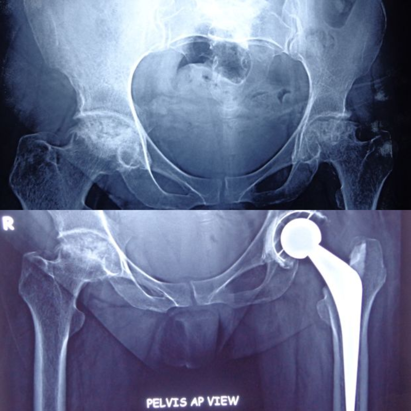 55 years old female, AVN of both femoral head. Total hip replacement (cemented) on left side