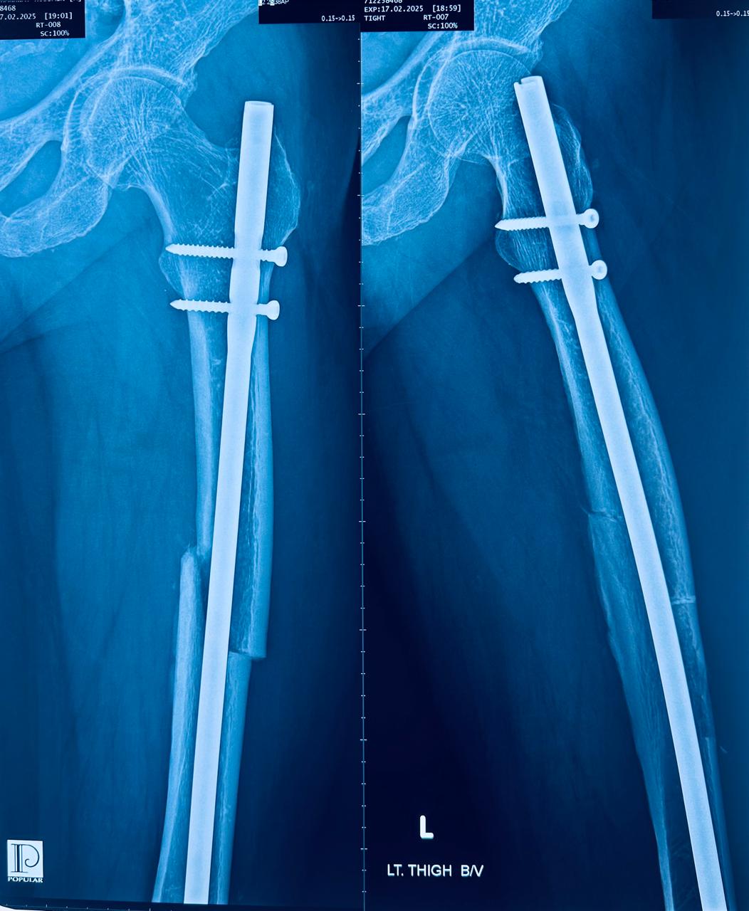 56 years old male comes with fracture shaft of left femur