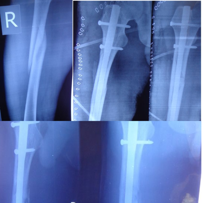 7 days old fracture shaft femur (Rt) of 23 years old young.