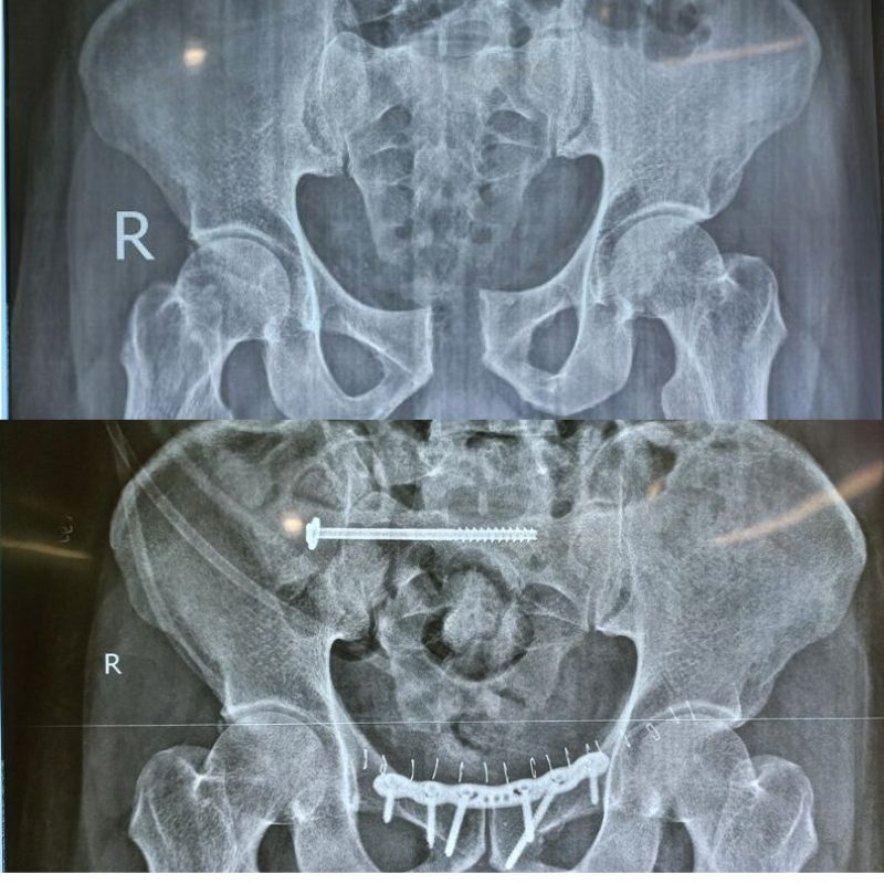 9 days old closed pelvic ring injury (APC- II)