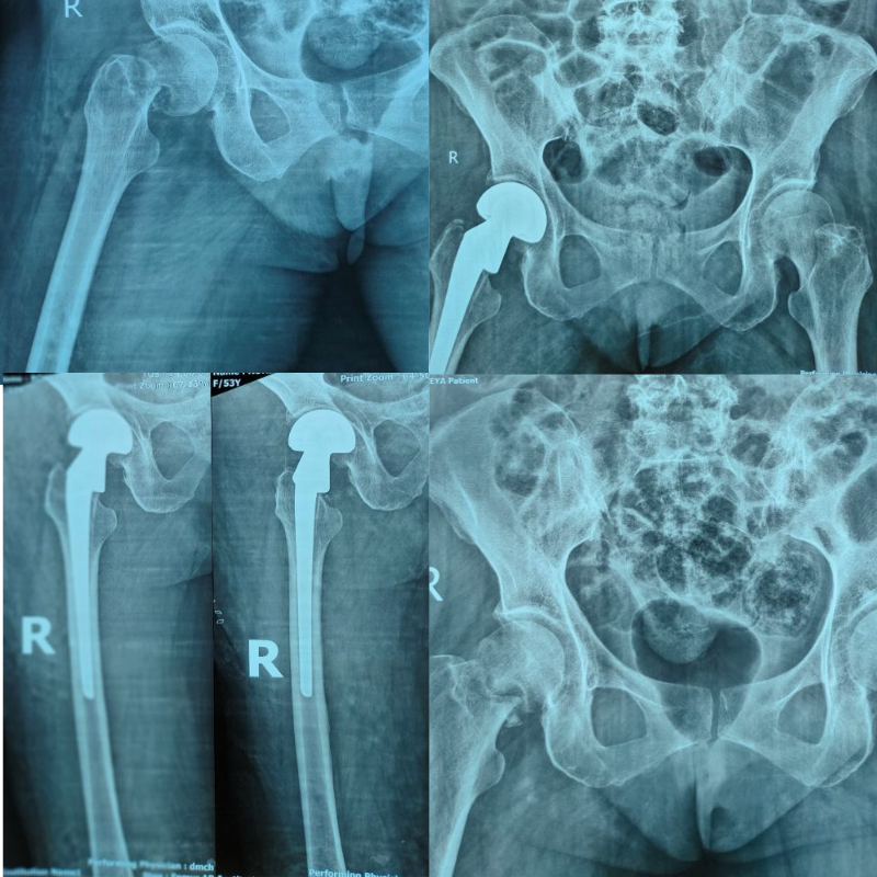 A case of 08 days old closed fracture Neck of Femur (Rt) in a 53 years old female.