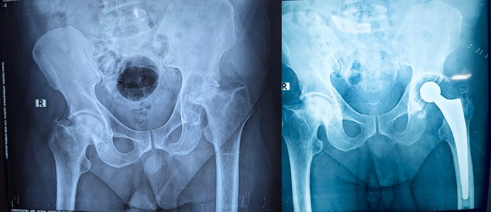 50 years old male, unable to walk