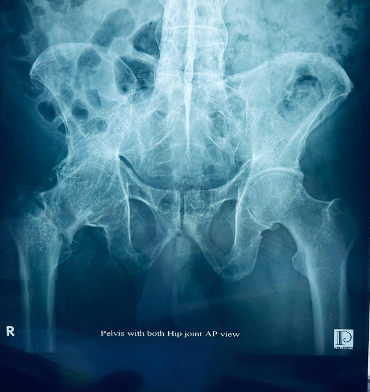 52 years old male having Ankylosed right Hip with fracture neck of femur