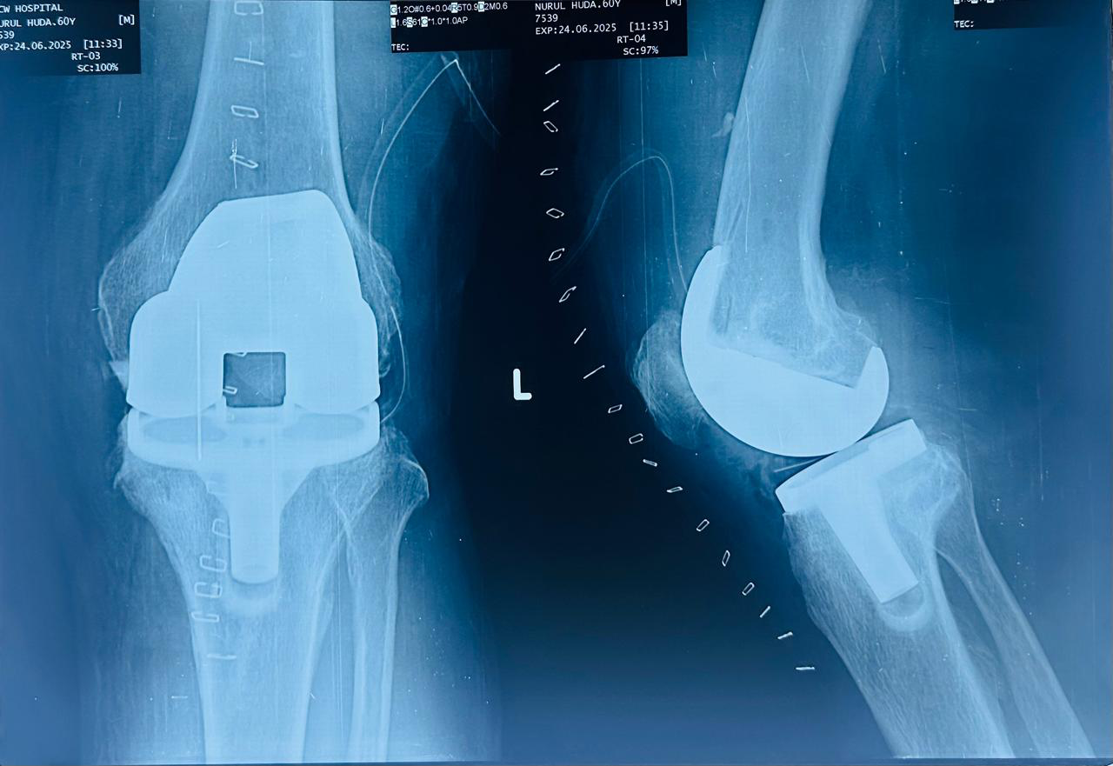 Total knee Replacement